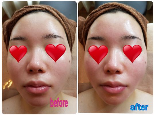 パワーレメディフェイシャルbefore、after！