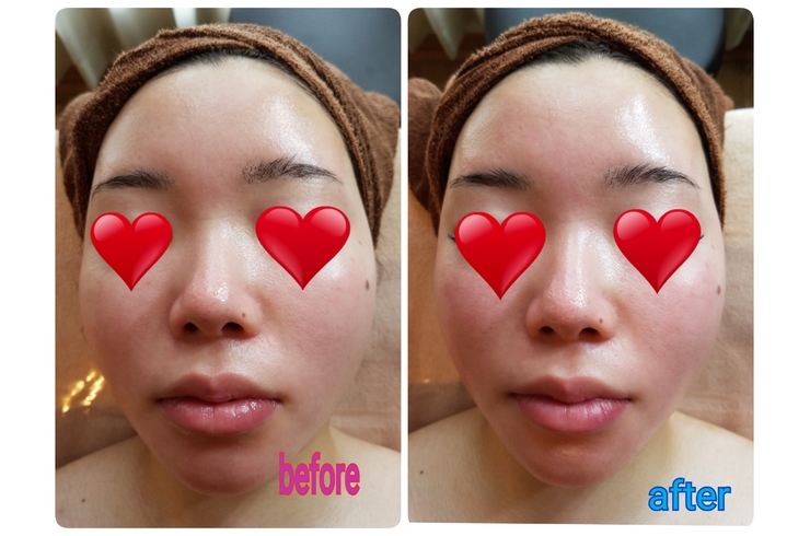 パワーレメディフェイシャルbefore、after！