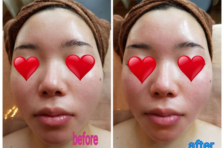 パワーレメディフェイシャルbefore、after！